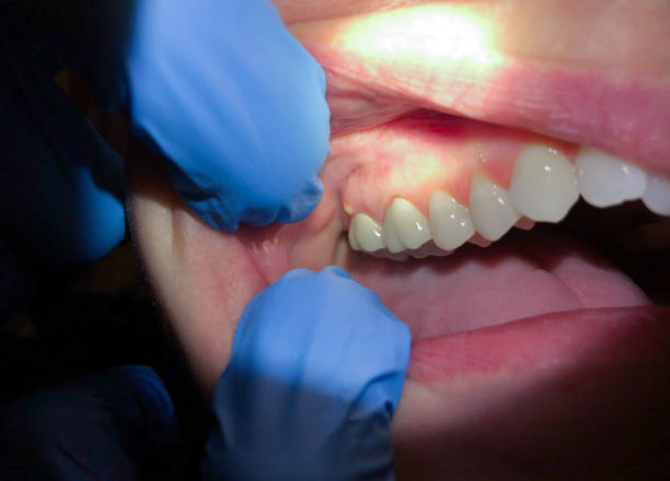 Best Broken or Chipped Tooth Repair in Horseshoe Bay, TX