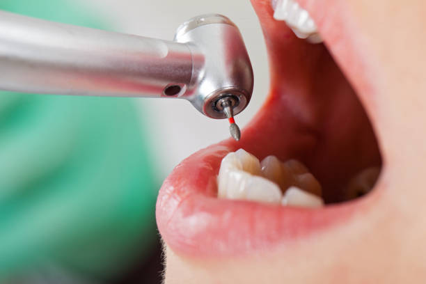 Best Broken or Chipped Tooth Repair in Horseshoe Bay, TX